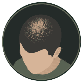Illustration of a thinning crown treated with scalp micropigmentation for added density