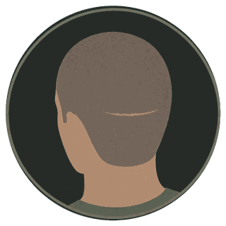 Illustration of a scalp scar softened with scalp micropigmentation camouflage