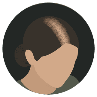 Illustration of a woman's widening part treated with scalp micropigmentation